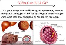 Viêm gan b là gì?Tổng quan về bệnh viêm gan B viem gan b la gi-phongkhamchuyengan