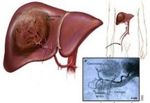 Cần biết gì về bệnh ung thư gan? Can biet gi ve benh ung thu gan